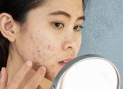 Simak 10 Tips Menghilangkan Jerawat secara alami
